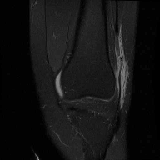 Figure 2 for case Lateral patellar retinaculum tear